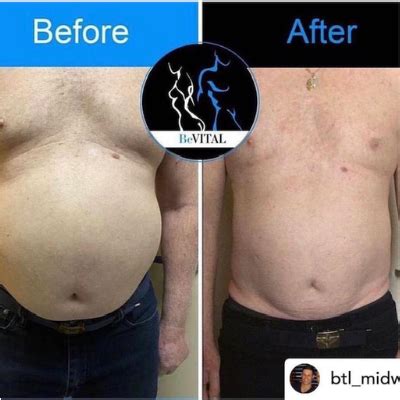 Emsculpt Neo: Decrease Visceral and Abdominal Fat, Increase .